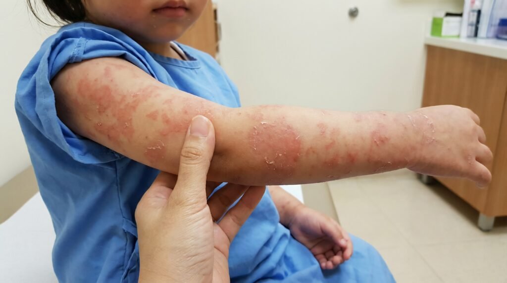 A young child in a medical setting shows a red, scaly skin condition on their arm while a healthcare professional performs a physical examination.