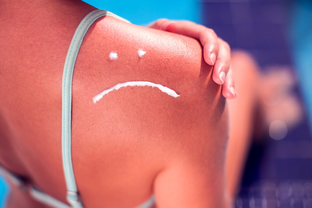 Woman with sun protection cream on her shoulder in the shape of sad smile. Summer, healthcare and vacation concept