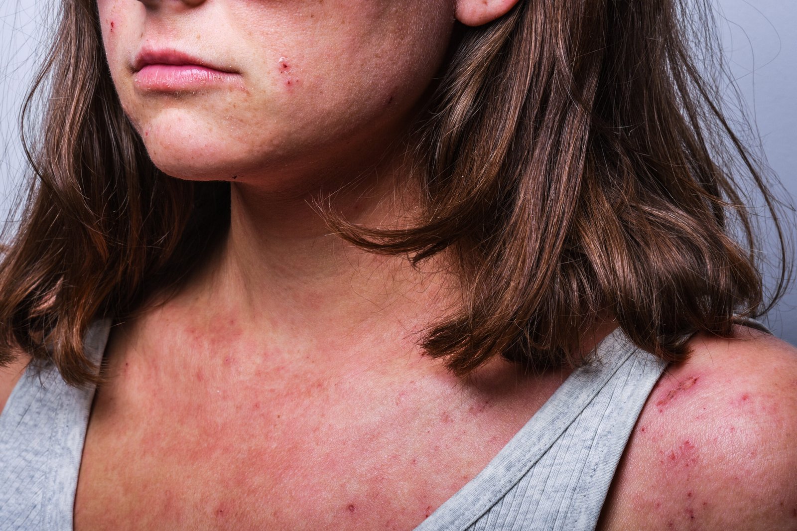 a young girl with atopic dermatitis in the acute stage. redness and scratching up to blood on the body close-up. dermatology