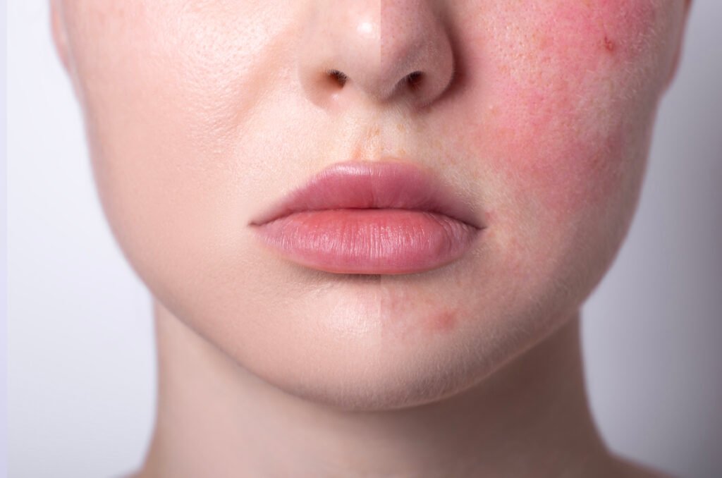 rosacea couperose redness skin, red spots on cheeks, young woman with sensitive skin, patient face before after result close-up