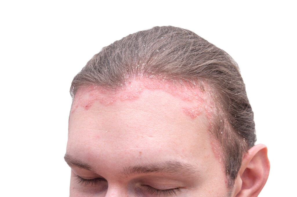 Isolated view of Psoriasis Vulgaris exacerbation on man's forehead and scalp. Red psoraitic spot on hairline. Dermatological disease, stress, seborrhea, dermatitis, appearance, eczema concept