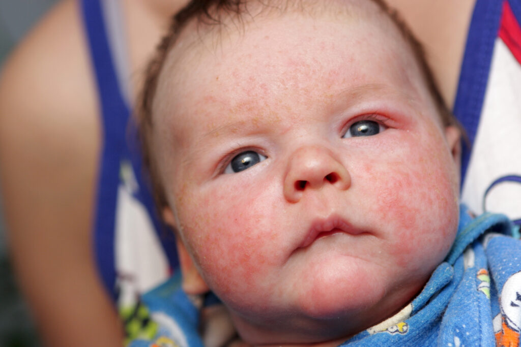 The newborn has eczema on his face