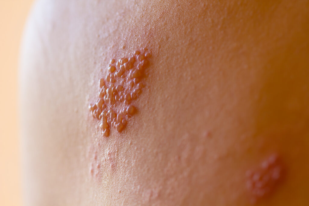 Shingles on men herpes zoster.