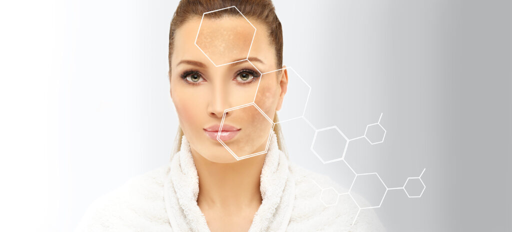 Hyperpigmentation: chloasma, melasma , age spots,Post-inflammatory hyperpigmentation.Hyperpigmentation removal