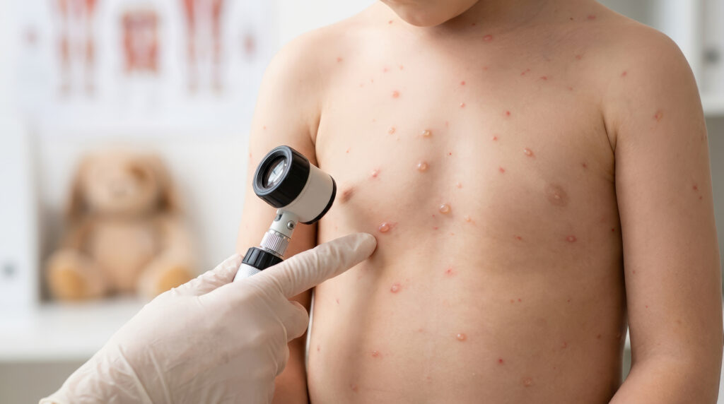 A close-up of a child's torso covered in red spots and fluid-filled blisters characteristic of chickenpox. A medical professional wearing a white glove uses a dermatoscope to examine a lesion on the child's chest in a clinic.