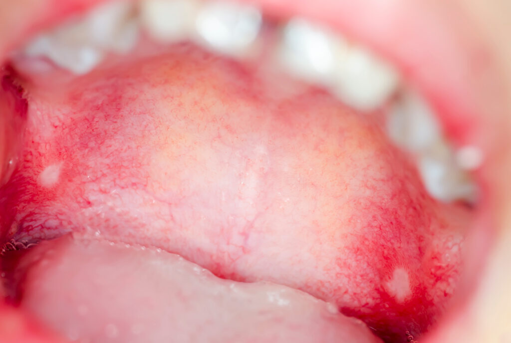 Macro close up and depth of field (DOF) infection in open mouth - infection of ulcer inside mouth