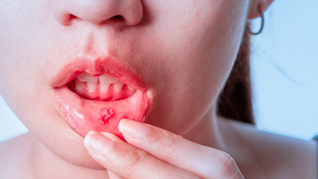 Asian women have aphthous ulcers on mouth on white background, selective focus.