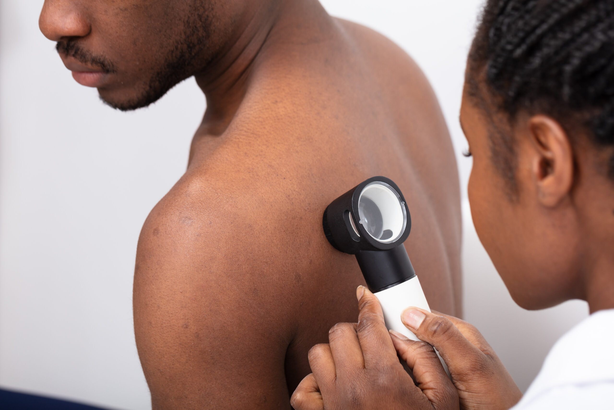 Close-up Of A Doctor Checking Pigment Skin On Man's Back