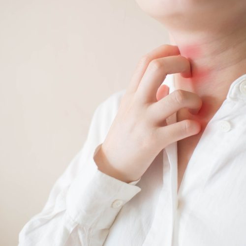 Young woman scratching the itch on her neck with redness rash. Cause of itchy skin include insect bites, dermatitis, food/drugs allergies or dry skin. Health care concept. Copy space. Close up.