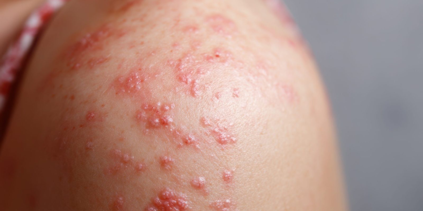Close-up of Skin with Molluscum Contagiosum: Highly Detailed Medical Image of Pearly Papules. Ideal for Dermatology, Medical Education, and Health Articles.